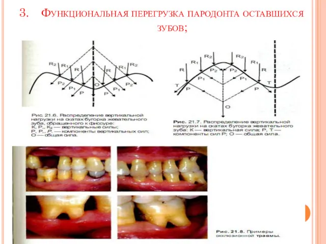 Функциональная перегрузка пародонта оставшихся зубов;