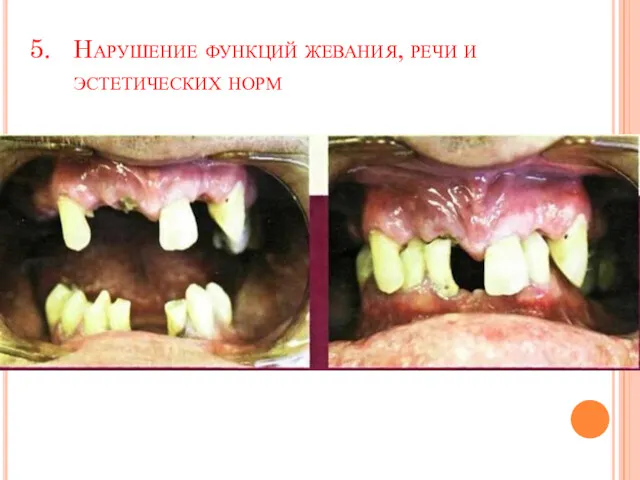 Нарушение функций жевания, речи и эстетических норм