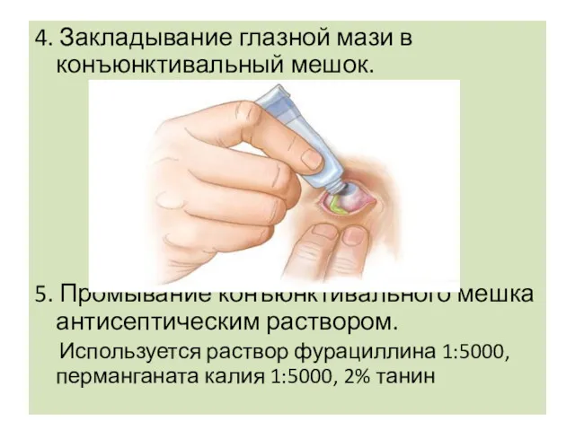 4. Закладывание глазной мази в конъюнктивальный мешок. 5. Промывание конъюнктивального