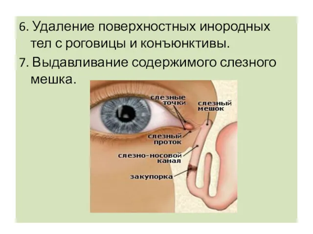 6. Удаление поверхностных инородных тел с роговицы и конъюнктивы. 7. Выдавливание содержимого слезного мешка.