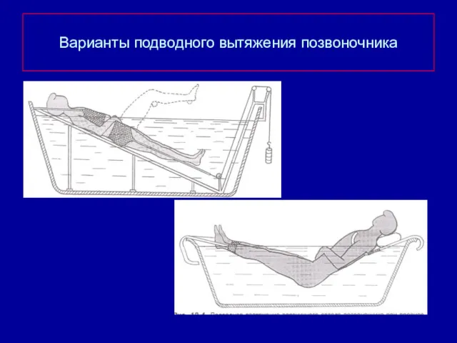 Варианты подводного вытяжения позвоночника