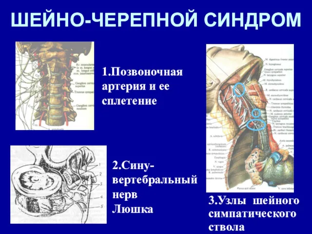 ШЕЙНО-ЧЕРЕПНОЙ СИНДРОМ 1.Позвоночная артерия и ее сплетение 2.Сину-вертебральный нерв Люшка 3.Узлы шейного симпатического ствола