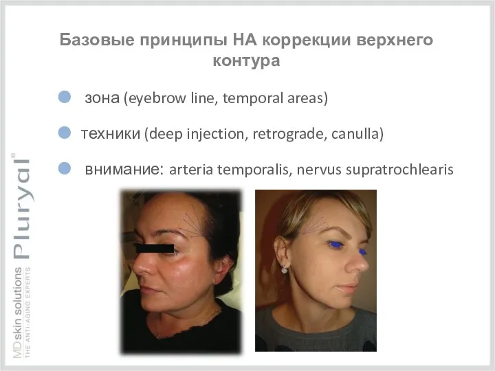 Базовые принципы НА коррекции верхнего контура зона (eyebrow line, temporal areas) техники (deep