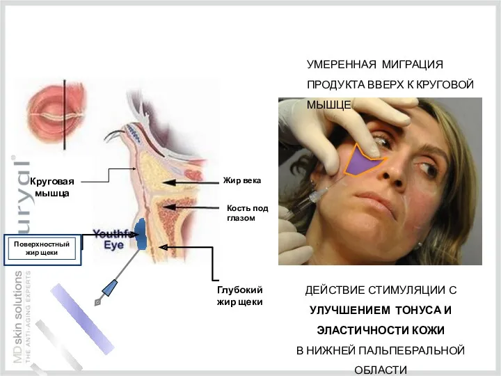 Жир века Кость под глазом Глубокий жир щеки Поверхностный жир