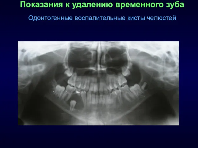 Показания к удалению временного зуба Одонтогенные воспалительные кисты челюстей