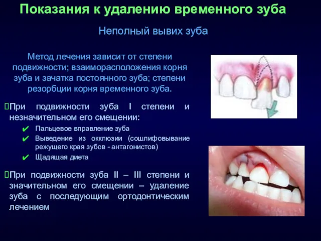 Показания к удалению временного зуба Неполный вывих зуба Метод лечения зависит от степени
