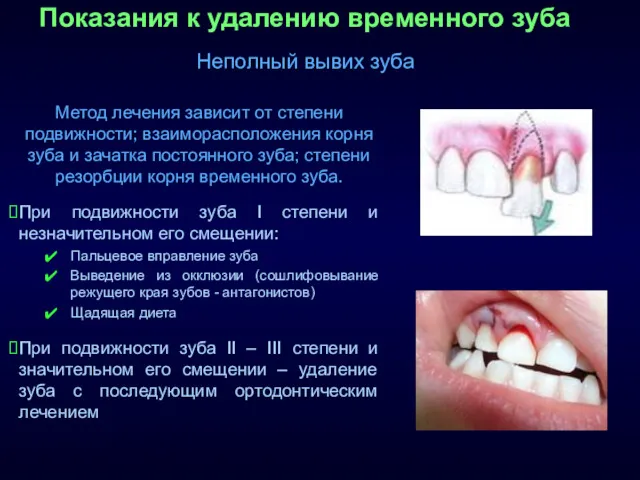 Показания к удалению временного зуба Неполный вывих зуба Метод лечения