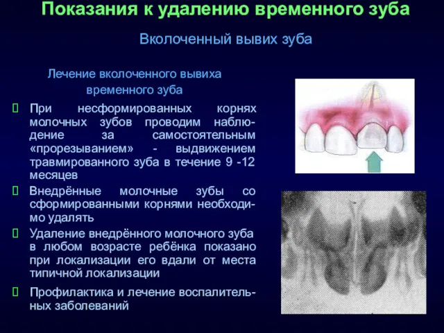 Показания к удалению временного зуба Вколоченный вывих зуба Лечение вколоченного