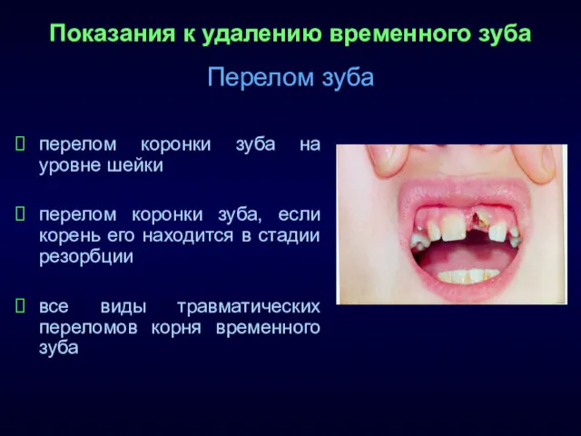 Показания к удалению временного зуба Перелом зуба перелом коронки зуба на уровне шейки