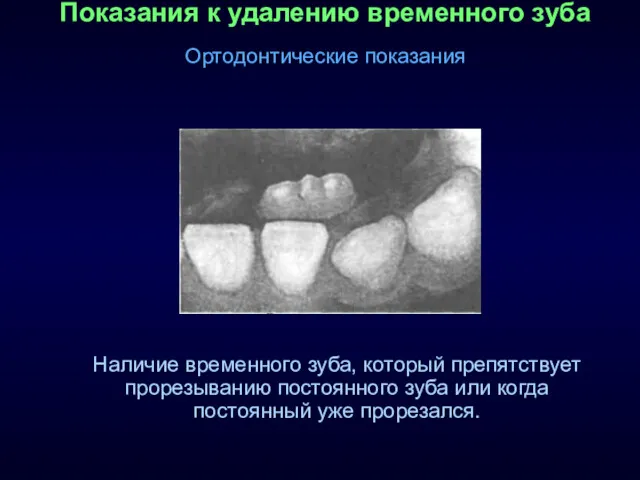 Показания к удалению временного зуба Ортодонтические показания Наличие временного зуба, который препятствует прорезыванию