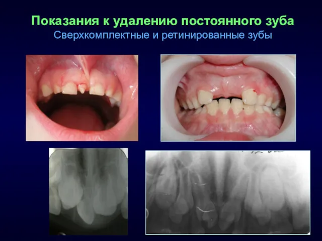 Показания к удалению постоянного зуба Сверхкомплектные и ретинированные зубы
