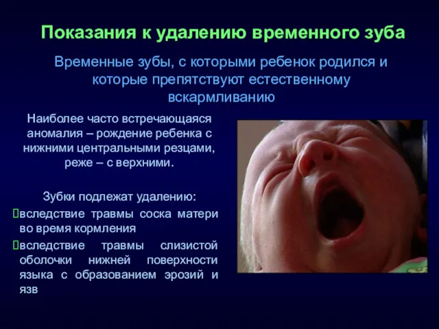 Показания к удалению временного зуба Наиболее часто встречающаяся аномалия –