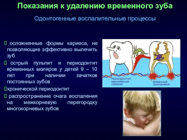 Показания к удалению временного зуба Одонтогенные воспалительные процессы осложненные формы кариеса, не позволяющие