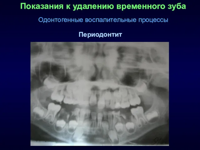 Показания к удалению временного зуба Одонтогенные воспалительные процессы Периодонтит