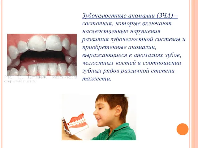 Зубочелюстные аномалии (ЗЧА) – состояния, которые включают наследственные нарушения развития зубочелюстной системы и
