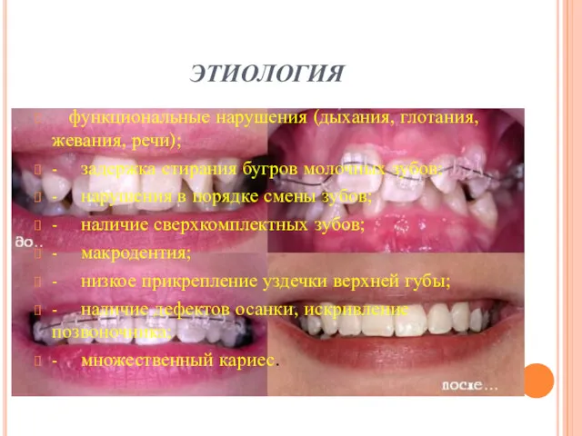 этиология функциональные нарушения (дыхания, глотания, жевания, речи); - задержка стирания бугров молочных зубов;