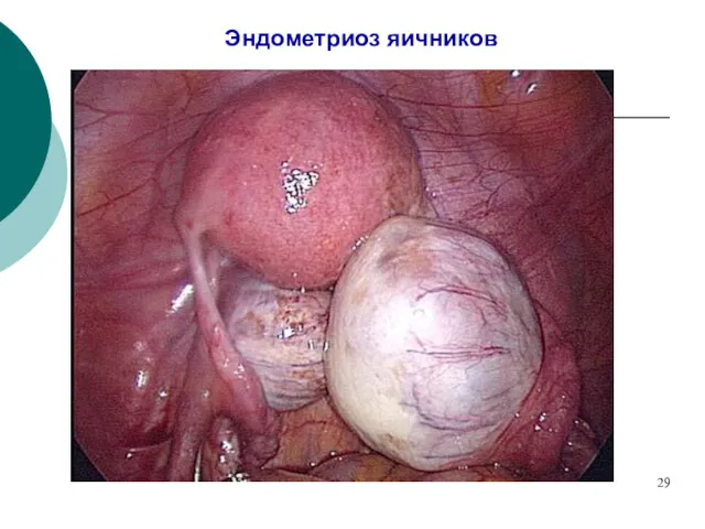 Эндометриоз яичников