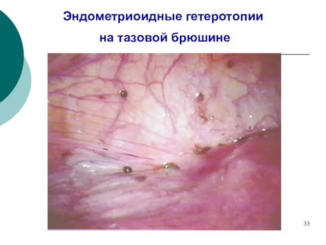 Эндометриоидные гетеротопии на тазовой брюшине