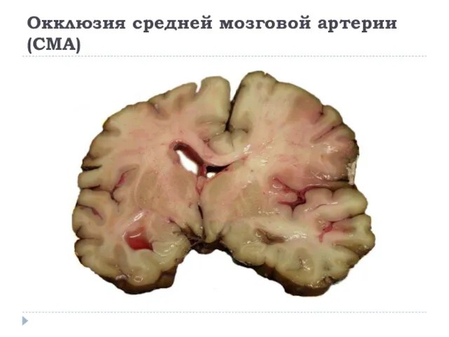Окклюзия средней мозговой артерии (СМА)