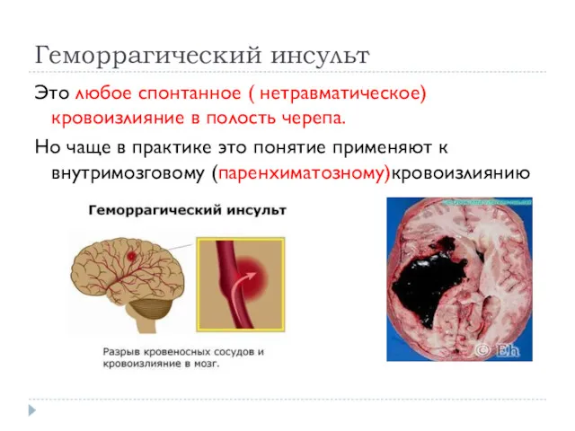 Геморрагический инсульт Это любое спонтанное ( нетравматическое) кровоизлияние в полость