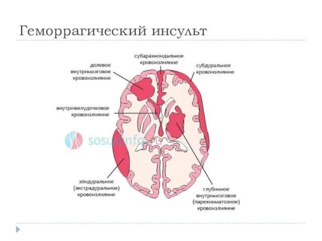 Геморрагический инсульт