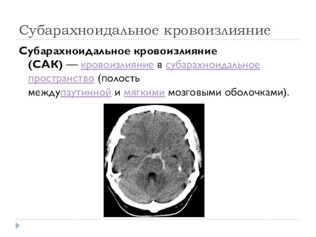 Субарахноидальное кровоизлияние Субарахноидальное кровоизлияние (САК) — кровоизлияние в субарахноидальное пространство (полость междупаутинной и мягкими мозговыми оболочками).