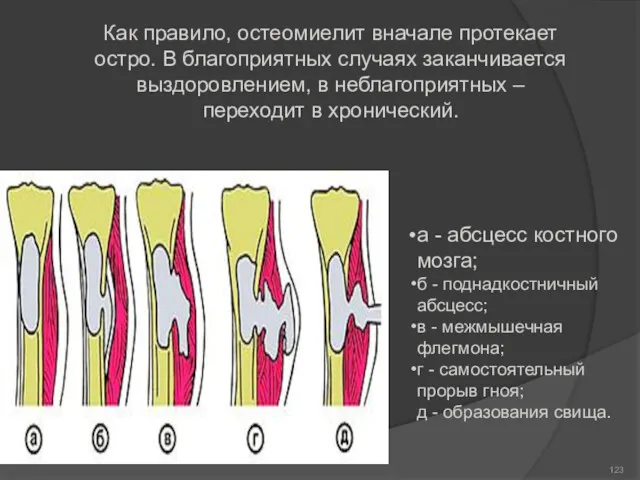 Как правило, остеомиелит вначале протекает остро. В благоприятных случаях заканчивается