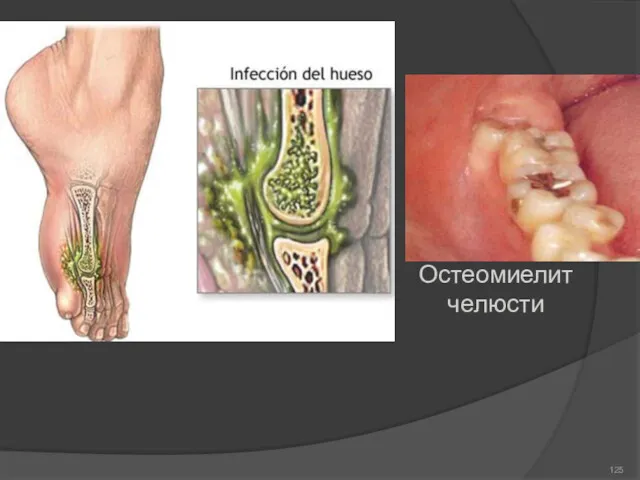 Остеомиелит челюсти