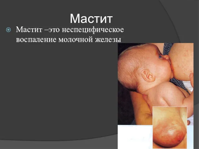 Мастит Мастит –это неспецифическое воспаление молочной железы