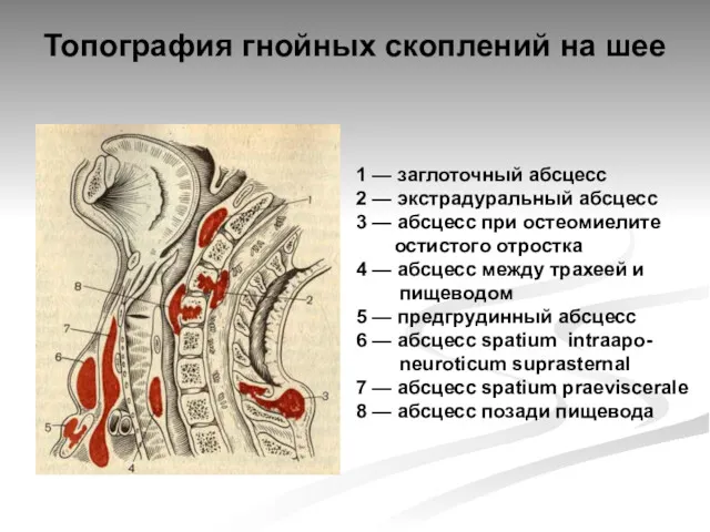 Топография гнойных скоплений на шее 1 — заглоточный абсцесс 2