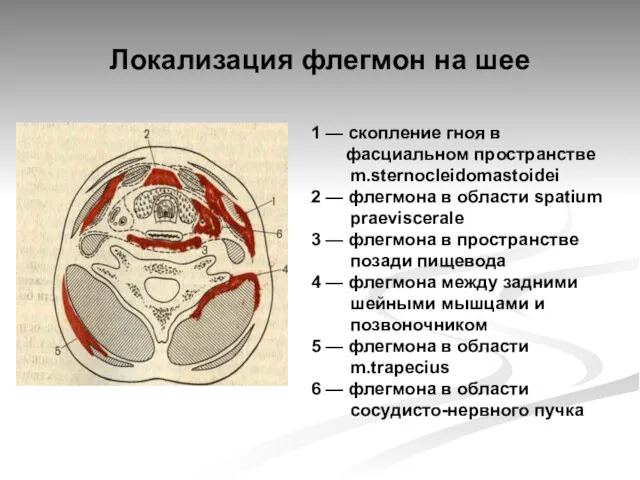 Локализация флегмон на шее 1 — скопление гноя в фасциальном