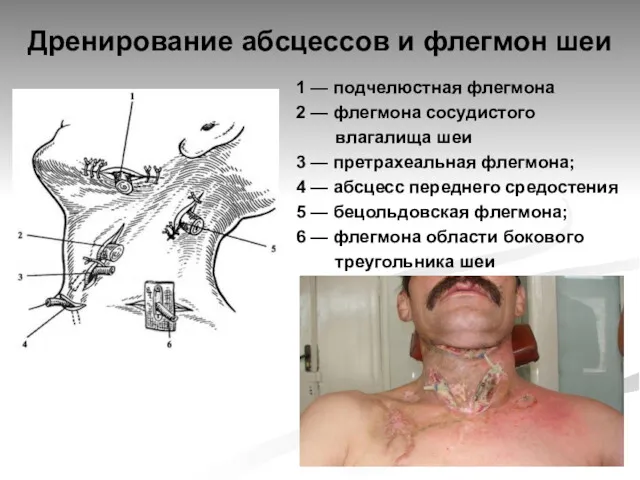 Дренирование абсцессов и флегмон шеи 1 — подчелюстная флегмона 2