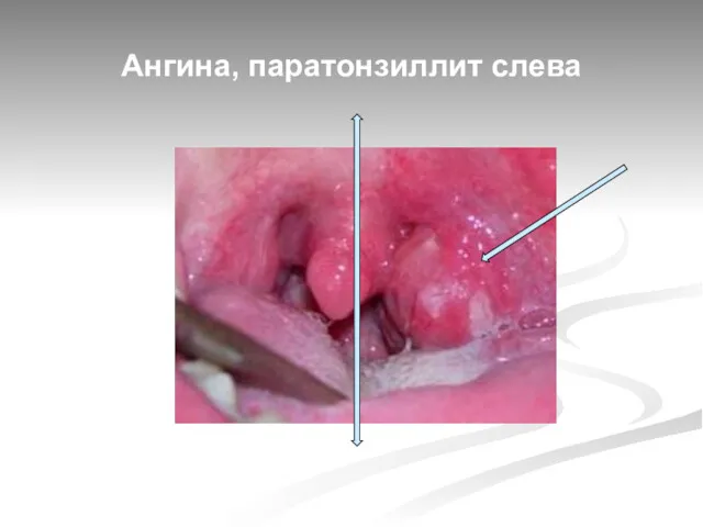 Ангина, паратонзиллит слева