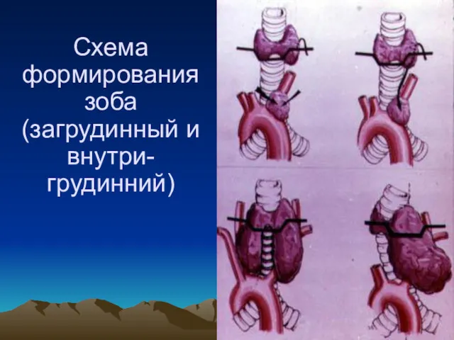 Схема формирования зоба (загрудинный и внутри-грудинний)