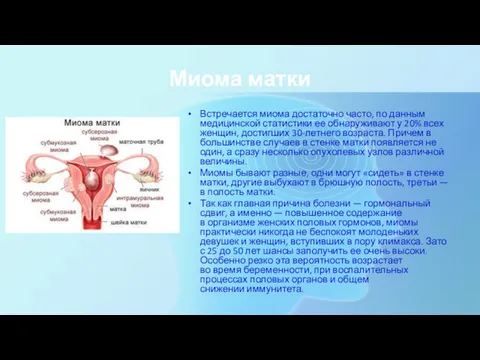 Миома матки Встречается миома достаточно часто, по данным медицинской статистики