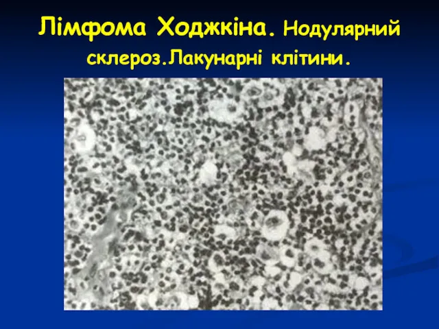 Лімфома Ходжкіна. Нодулярний склероз.Лакунарні клітини.