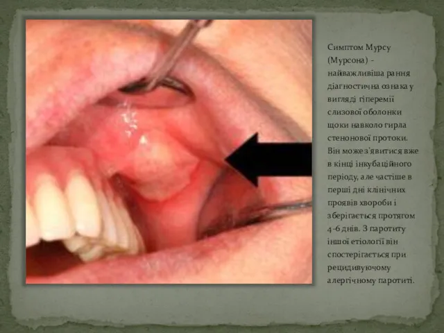 Симптом Мурсу (Мурсона) - найважливіша рання діагностична ознака у вигляді