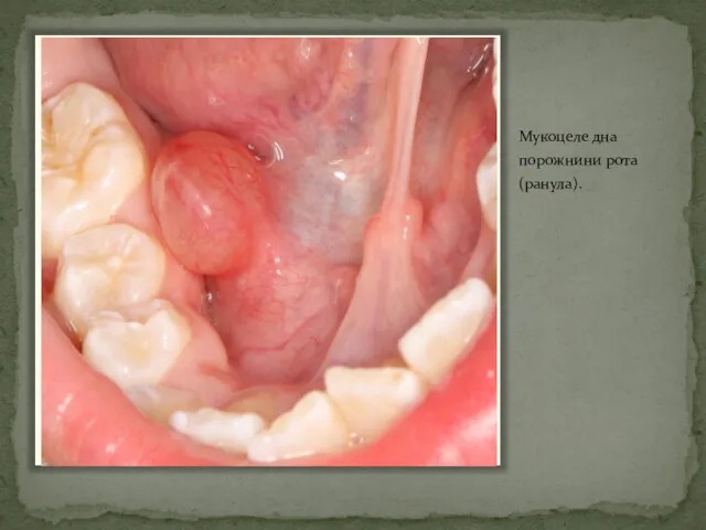 Мукоцеле дна порожнини рота (ранула).