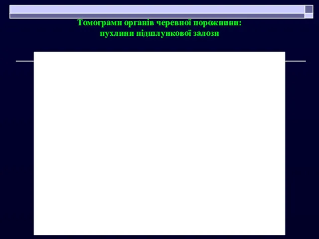 Томограми органів черевної порожнини: пухлини підшлункової залози