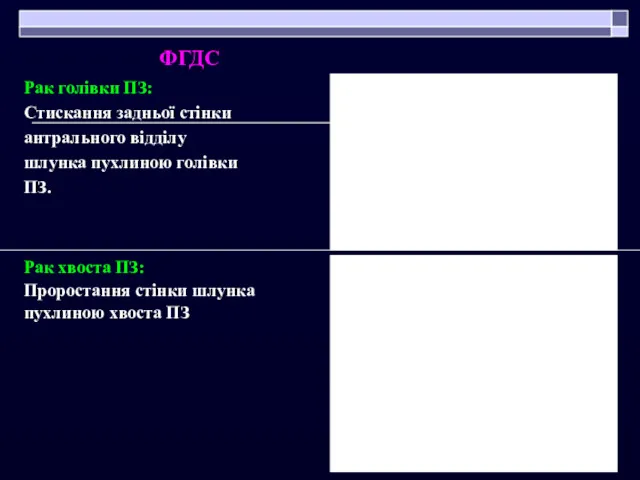 Рак голівки ПЗ: Стискання задньої стінки антрального відділу шлунка пухлиною