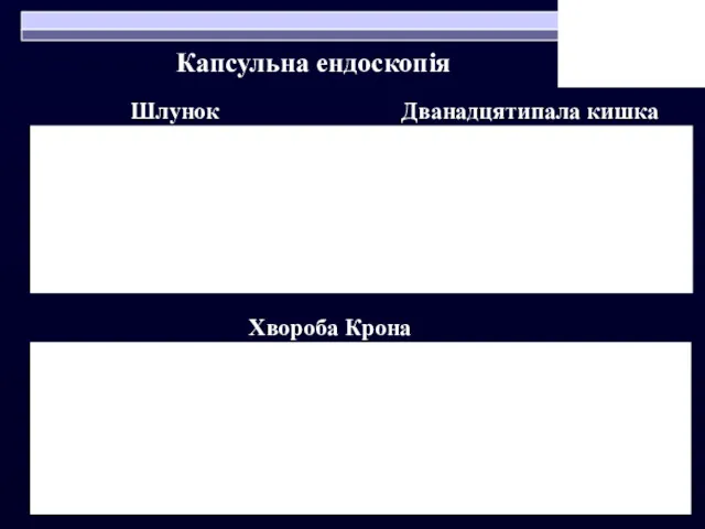 Хвороба Крона Шлунок Дванадцятипала кишка Капсульна ендоскопія