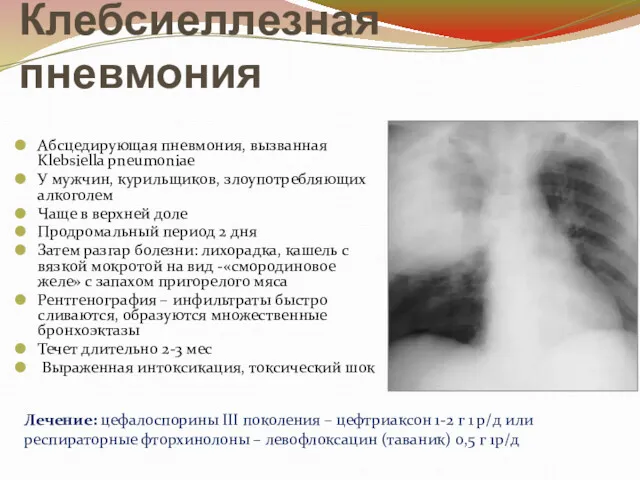 Клебсиеллезная пневмония Абсцедирующая пневмония, вызванная Klebsiella pneumoniae У мужчин, курильщиков,
