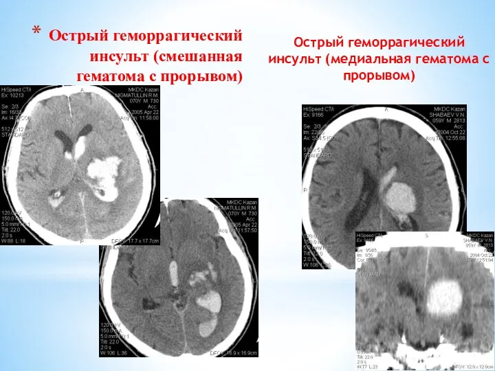 Острый геморрагический инсульт (смешанная гематома с прорывом) Острый геморрагический инсульт (медиальная гематома с прорывом)