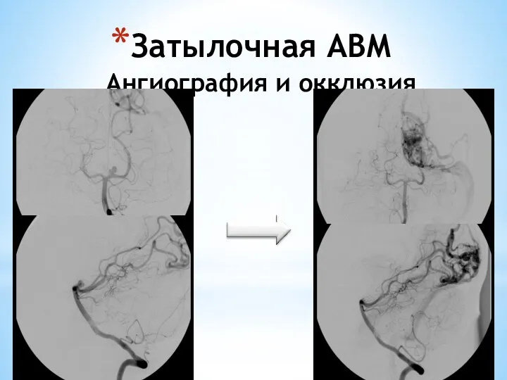 Затылочная АВМ Ангиография и окклюзия