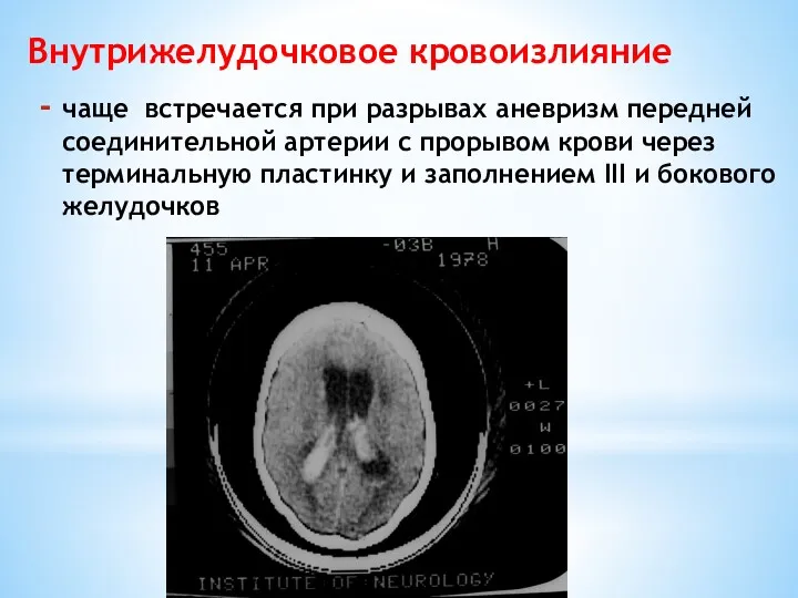 чаще встречается при разрывах аневризм передней соединительной артерии с прорывом