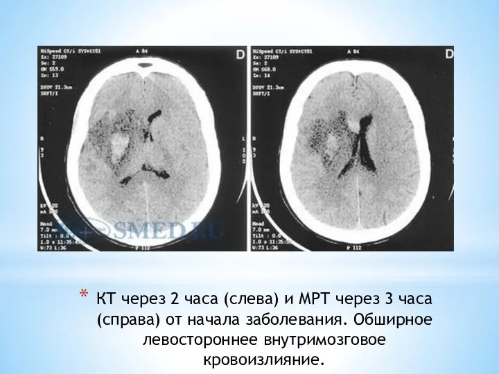 КТ через 2 часа (слева) и МРТ через 3 часа