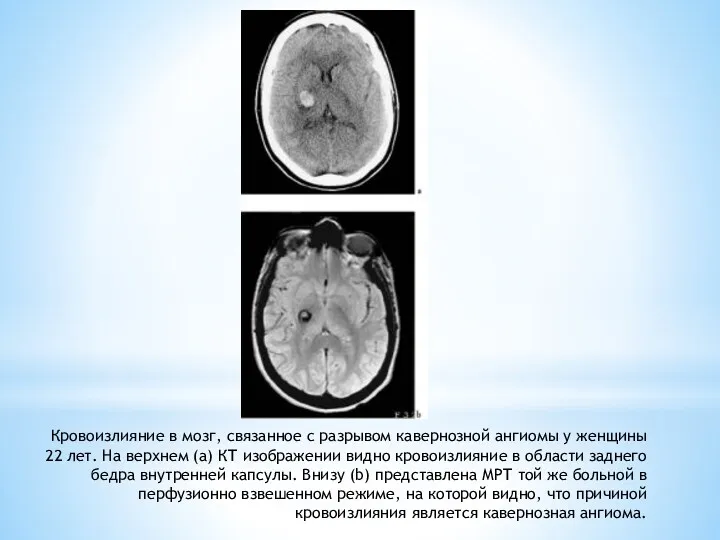 Кровоизлияние в мозг, связанное с разрывом кавернозной ангиомы у женщины