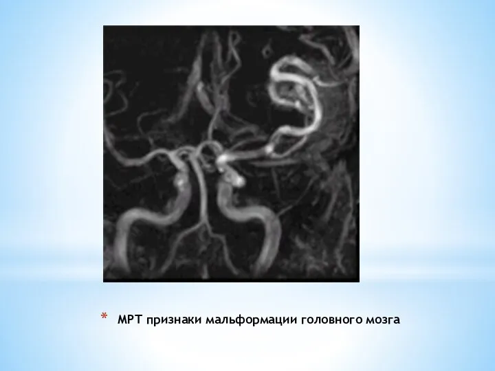 МРТ признаки мальформации головного мозга