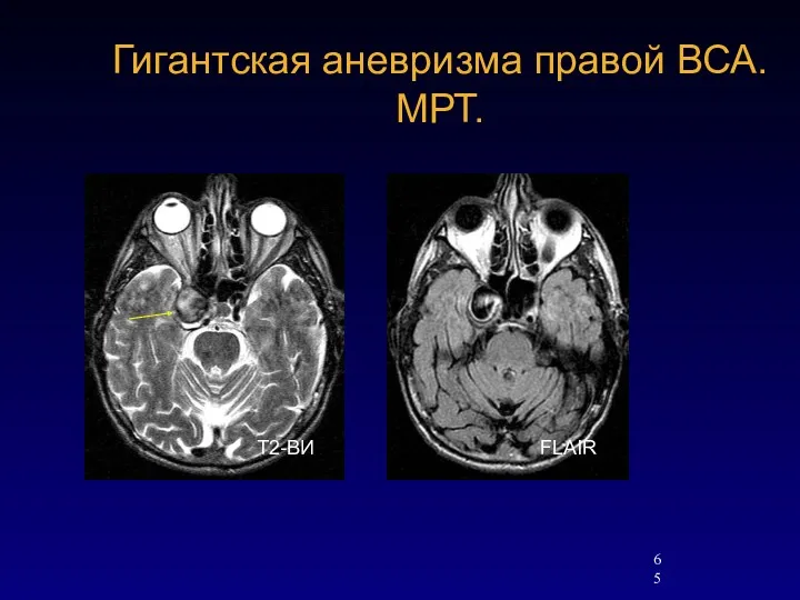 Гигантская аневризма правой ВСА. МРТ. Т2-ВИ FLAIR