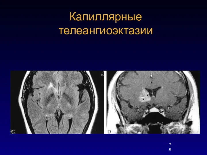 Капиллярные телеангиоэктазии